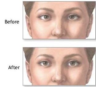 Correcting Lazy Eye In Adults 45