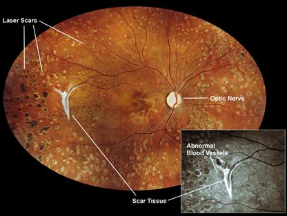 Systemic Lupus Erythematosus