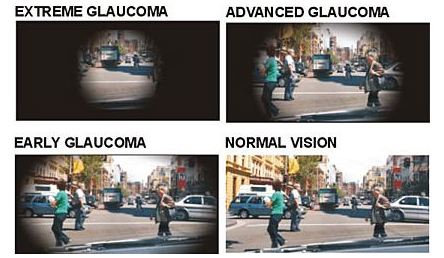 treat glaucoma washington dc